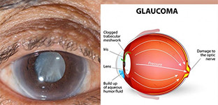 Tomares glaucoma