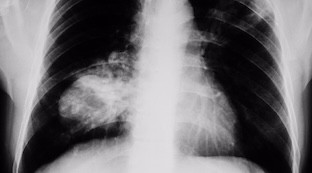 IA cancer pulmon
